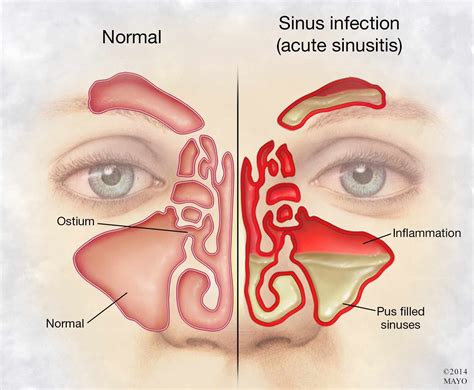 Mayo Clinic Q & A: Chronic sinusitis symptoms resemble a cold, but last months - Mayo Clinic ...
