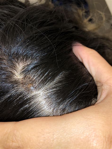 Painless lump on scalp? I’ve had this lump on my head for a few years now and it just hasn’t ...
