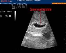 gestazionale senza embrione cause 5 settimane gestazionale senza embrione cause 5 settimane