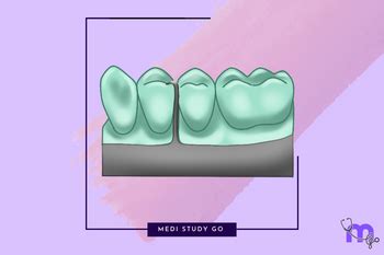 Rest and Rest Seats in RPD: Clinical Applications – Medi Study Go