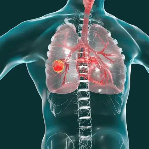 Image result for Needle Decompression Interior View