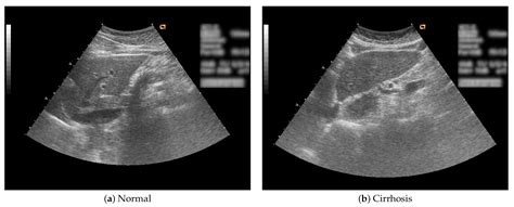 Normal Liver Ultrasound Labeled Anomalies and Anatomic Variants of the ...