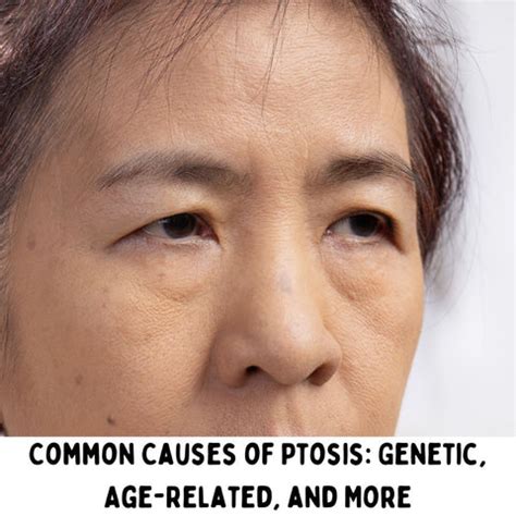 Droopy Eyelids (Ptosis): Causes, Treatments | Clinikally
