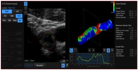 New Technologies in the Assessment of Carotid Stenosis: Beyond the ...