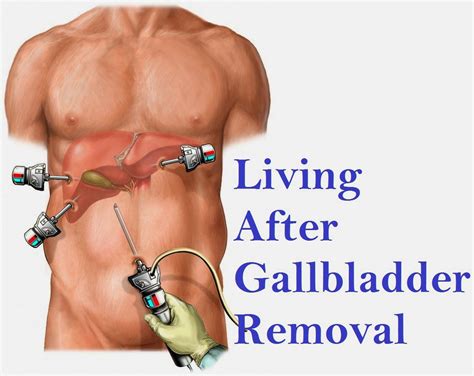 Gallbladder Surgery Recovery Time