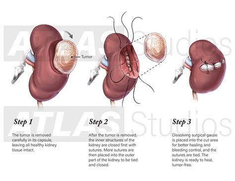 Image result for Hal Nephrectomy