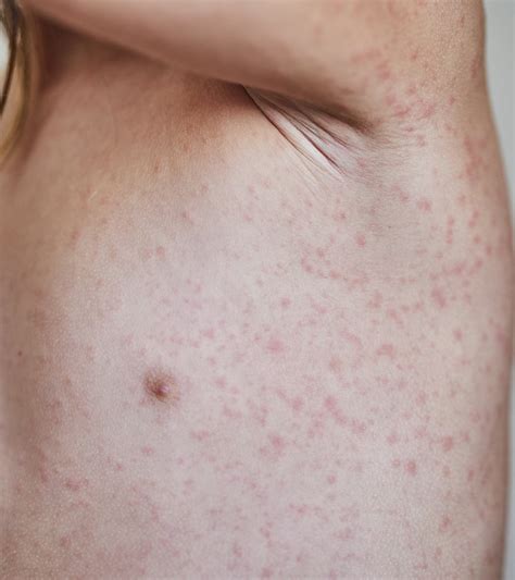 Amoxicillin Rash: Is It Really An Allergy? Doctors Explain