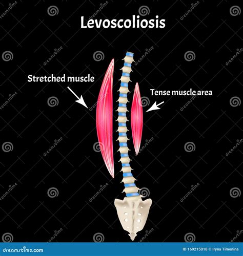 Left-sided Scoliosis. Levoscoliosis. Muscles and Spine. Spinal Curvature in Scoliosis ...