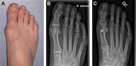 Posttraumatic Pathologies of the First Metatarsophalangeal Joint - Foot ...