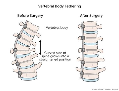 Vertebral Body Tethering | Boston Children's Hospital