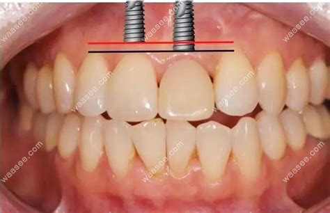 瑞士iti骨水平和龈水平种植体的区别在于适应症的不同 - 口腔资讯 - 牙齿矫正网