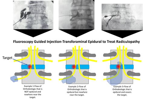 Image result for Fluoroscopy Injection