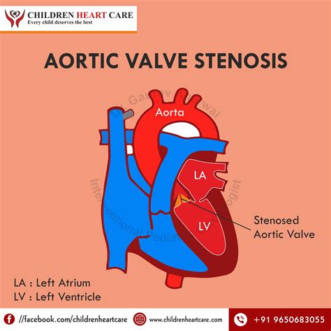 Congenital Aortic Stenosis