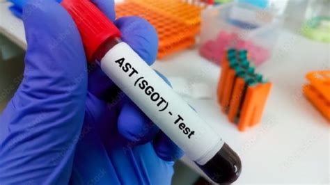 Pemeriksaan AST/SGOT untuk Mengetahui Kondisi Fungsi Hati - Primaya Hospital