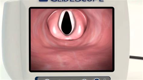 Image result for GlideScope Tutorial