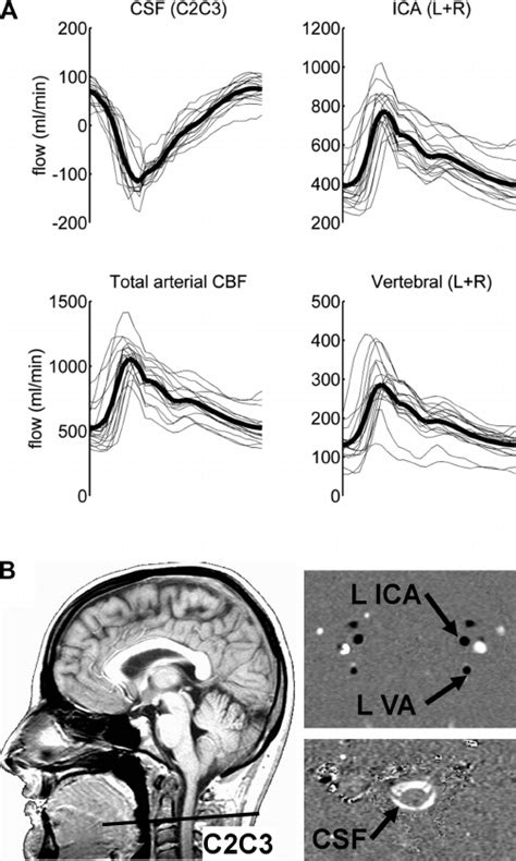 CSF Flow MRI 的图像结果