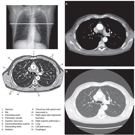 Chest CT Scan Imaging - RadTechOnDuty