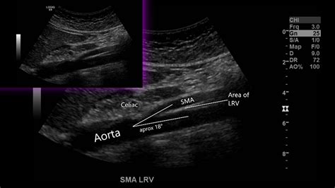 Nutcracker Phenomenon/Syndrome – Sonographic Tendencies