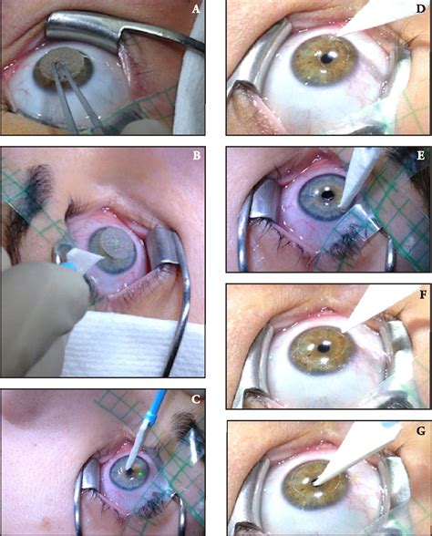 Photorefractive Keratectomy