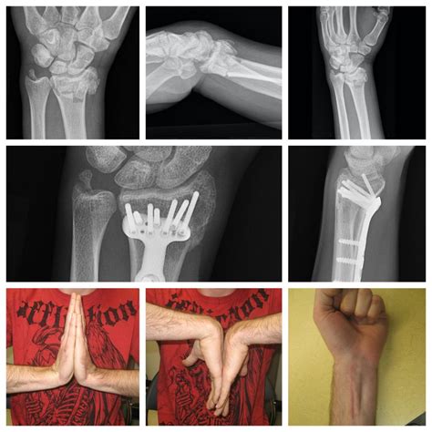 wrist fracture surgery in Raleigh