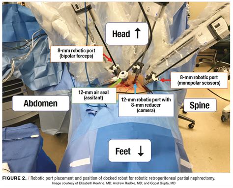 Image result for Robotic Retroperitoneal Partial Nephrectomy