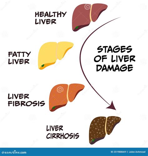 Stages Of Liver Damage, Liver Disease. Healthy, Fatty, Liver Fibrosis And Cirrhosis On Blue ...