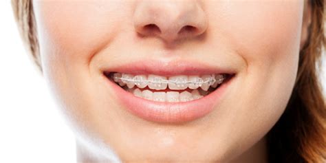 Clear Braces in Hyderabad | Finedent Dental clinics