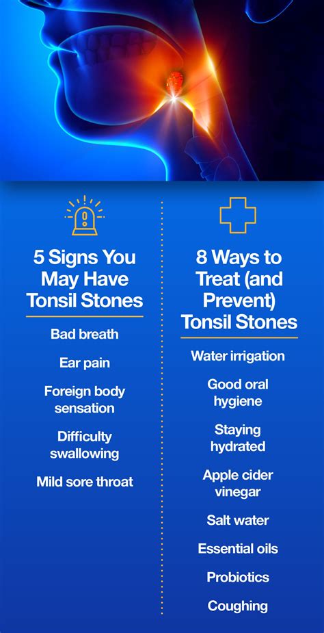 Tonsil Stones Cause Colds at Angela Knight blog