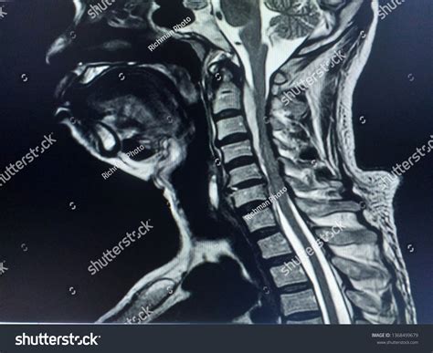 sos mri cervical spineDownload it from sos mri cervical spine for free 5.66