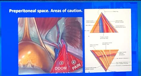 Triangle Of Pain Anatomy SAPHENOUS NERVE; Anatomy, Pain, And ADDUCTOR