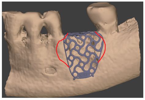 Digital Customized Titanium Mesh for Bone Regeneration of Vertical ...