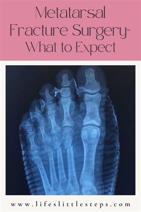 stress fracture in foot