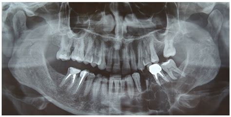 Full Digital Workflow for Mandibular Ameloblastoma Management: Showcase ...