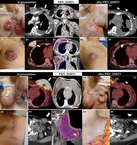 Adaptive Repeat Quad Shot Radiation Therapy for Uncontrolled Symptomatic Fungating or Skin ...
