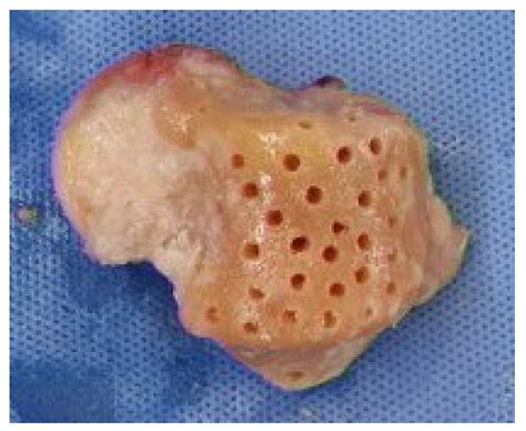Talar Allografts in Tibiotalocalcaneal Arthrodesis: A Salvage Approach ...