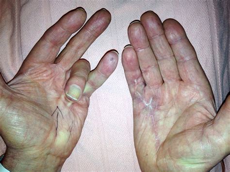 Bildergebnis für dupuytren's surgery pictures