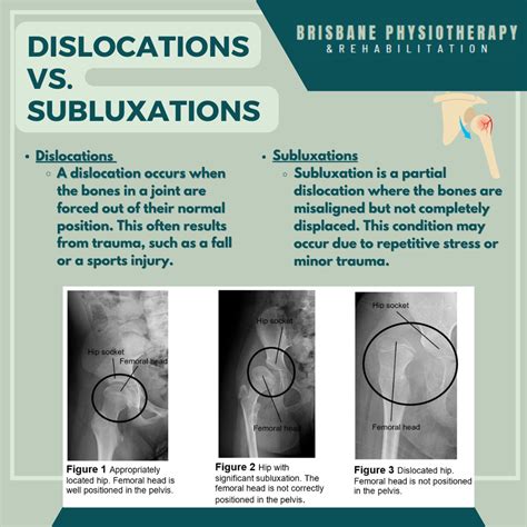 Dislocations vs. Subluxations - Brisbane Physiotherapy & Podiatry