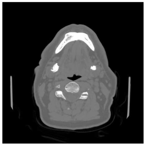 Hybrid Exoscopic and Robotic Transoral Removal of a Bilateral Hilar ...