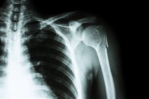 Image result for Poumon Normal Scanner