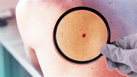 Red Moles on Skin: Causes and Treatment of Cherry Angiomas