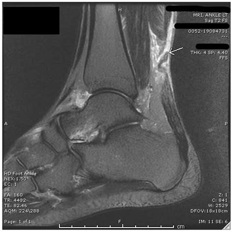 Bilateral Achilles Tendon Rupture: A Case Report and Review of the ...