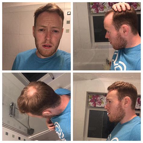 Buzz Cut With Bald Crown