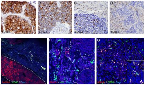 Roles of Annexin A1 Expression in Small Cell Lung Cancer