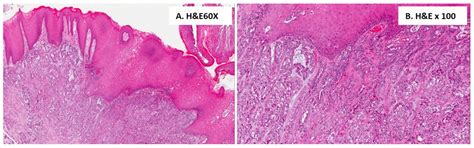 Polymorphous Adenocarcinoma: A Systematic Review of the Literature and ...