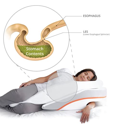 How to sleep with acid reflux and heartburn – Artofit