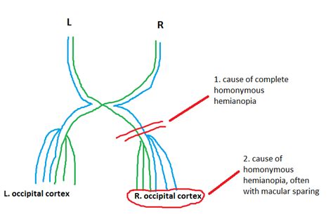 Image result for Contralateral Homonymous Hemianopsia