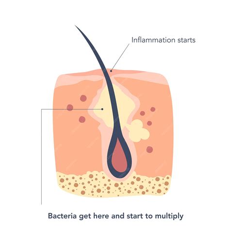 Premium Vector | Inflamed skin around the hair follicles deep in the pores second stage of ...
