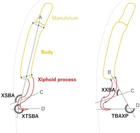 Xiphoid Process Inflammation Sternum Physiopedia