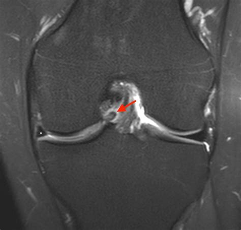 Bucket-handle Tear of the Meniscus - Radsource
