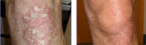 Small Patches - Eczema and Psoriasis Care Bundle – Oleum Cottage